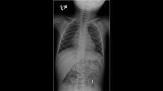 An X-ray shows two magnetic beads in the toddler's throat, and four in his abdomen. 