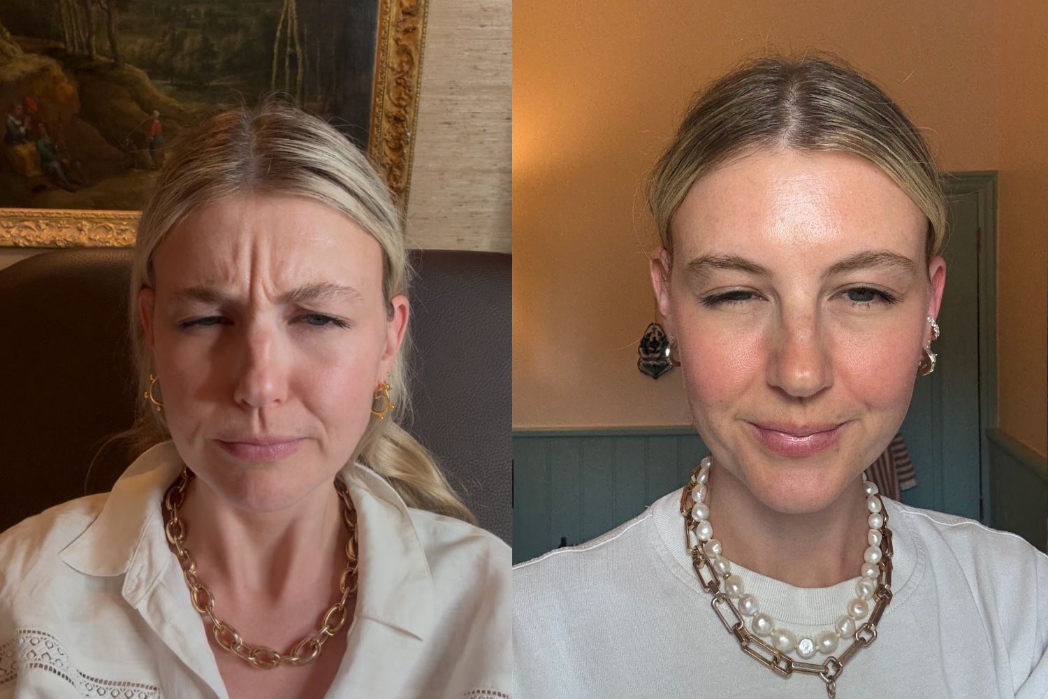 Katie Thomas before and after Botox treatment