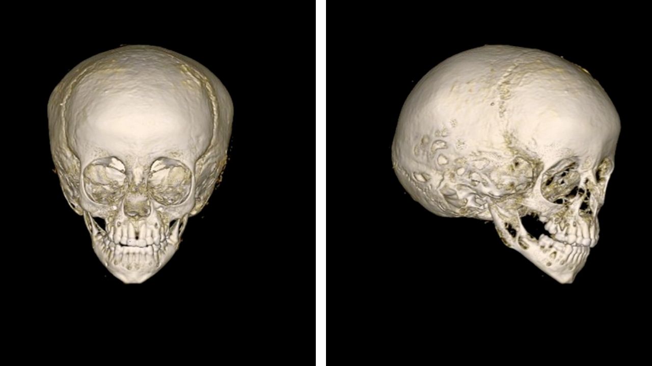 A 3D reconstruction of the boy's skull.