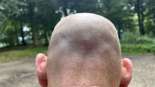 Abus Cliffhanger love bite on back of a bald head
