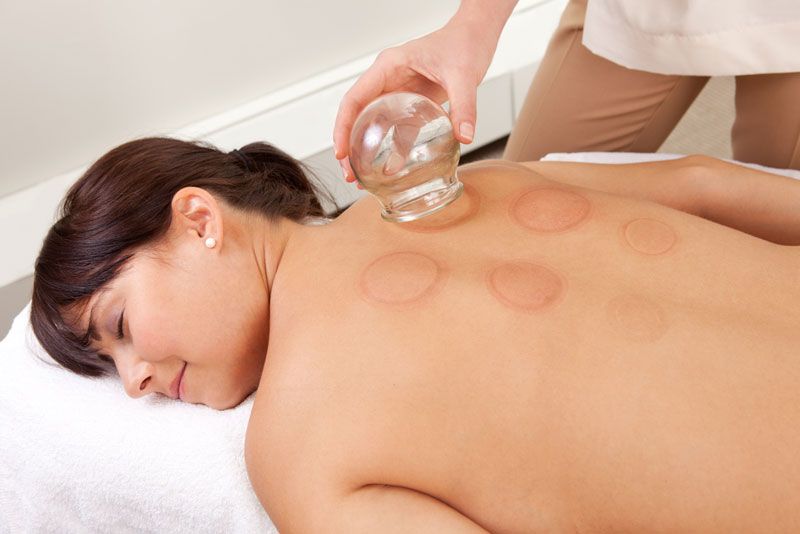 A woman with marks on her back after cupping therapy.