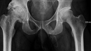 An X-ray of a man&#039;s pelvis showing the faint outline of a bone inside his penis