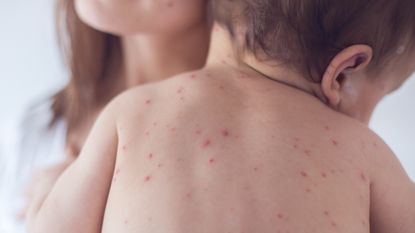 Child with measles