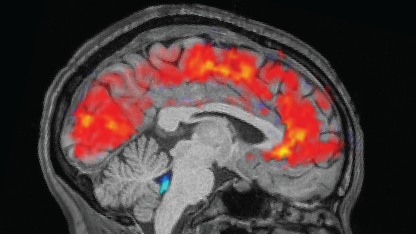 Study reveals why the brain 'zones out' when you're exhausted