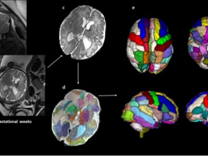 Brain differences tied to autism can be detected in the womb