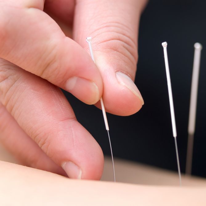 What is Acupuncture? | Does Acupuncture Work? | Live Science