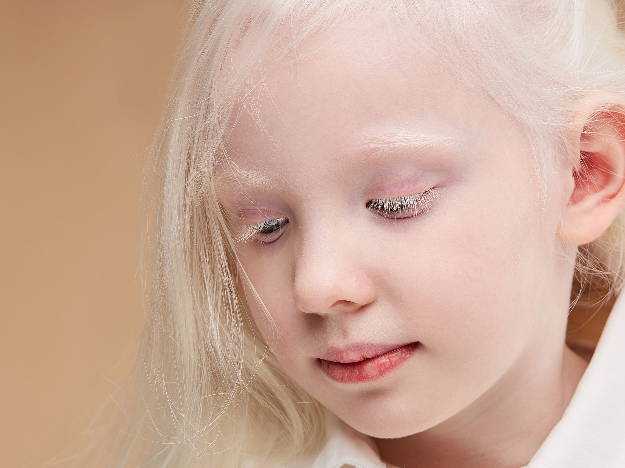 What if all humans on Earth had albinism? | Live Science, image size:2100x1575