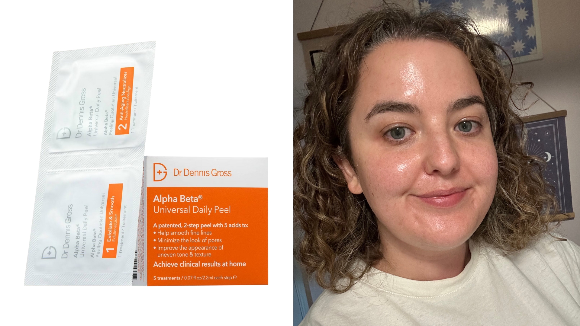 On the left, Dr Dennis Gross Alpha Beta&amp;reg; Universal Daily Peel and on the right, an image of Rhiannon Derbyshire with makeup-free skin