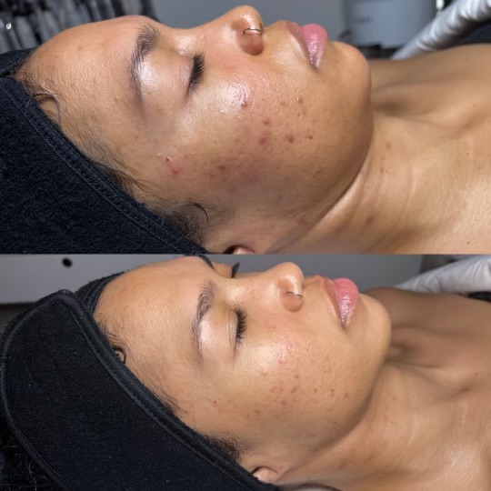 VI Peel Before and After Results for Acne