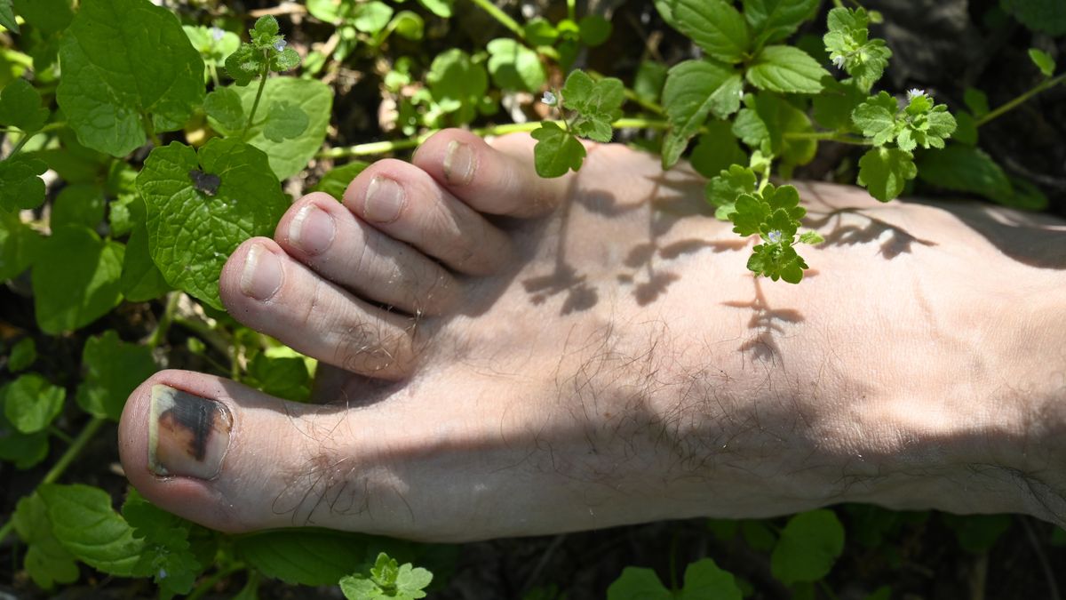 A hiker&#039;s foot in the foliage with a bruised toenail