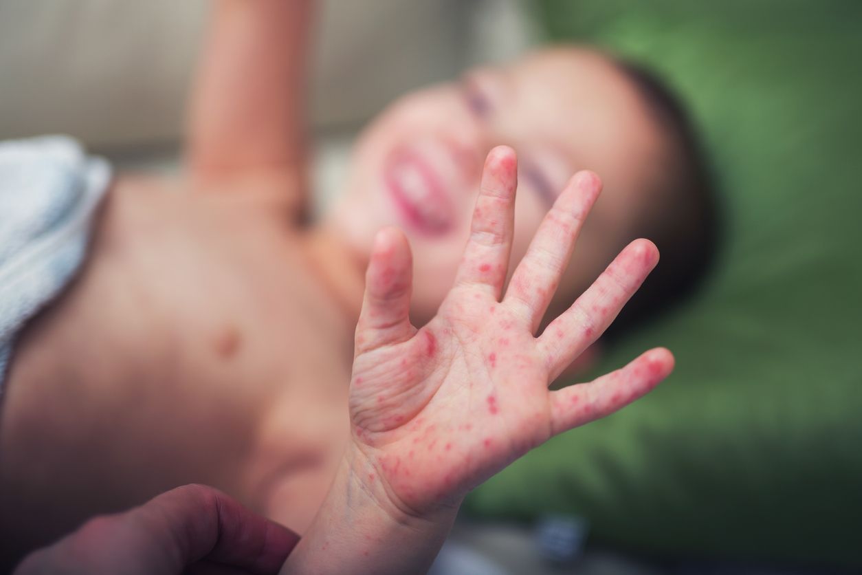 Child with measles.