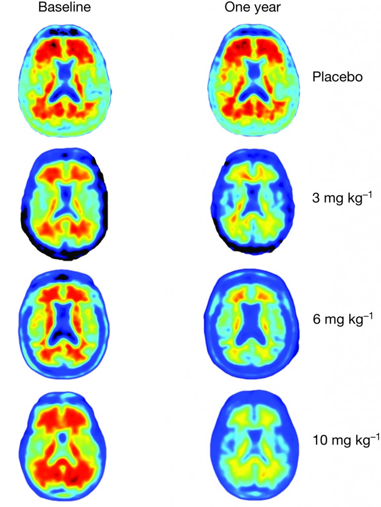 amyloid plaques removed from brain scans