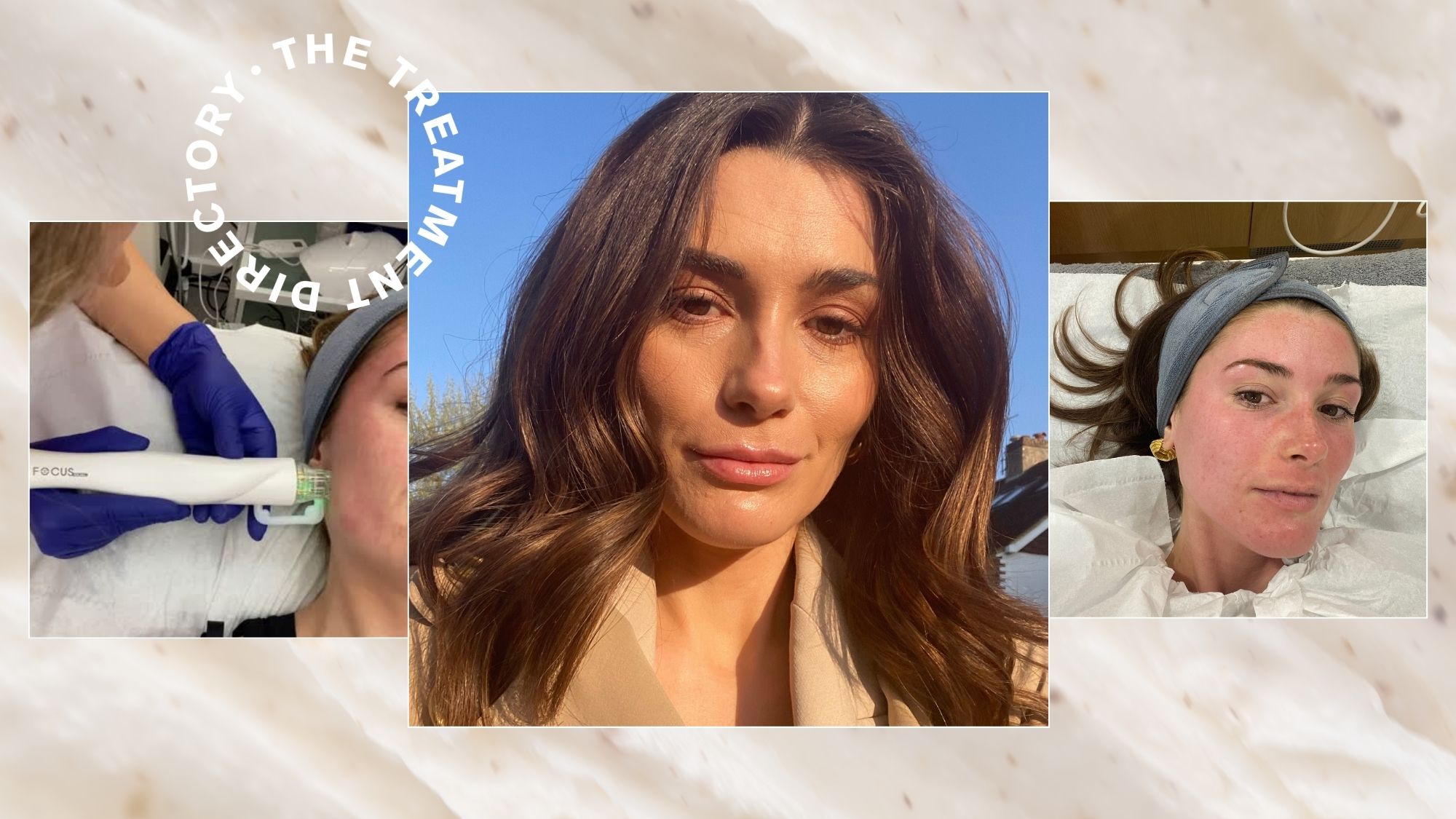 A graphic with pictures of beauty editor Eleanor Vousden having a RF microneedling treatment