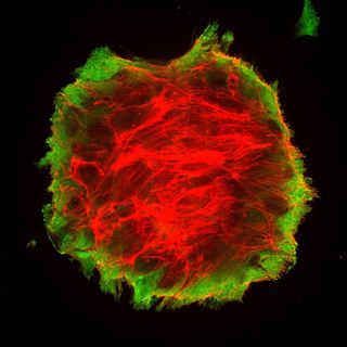 Here, the breast cancer cells are beginning to detach from the surface to form a spheroid, with actin cytoskeleton (red) stretching the bonds to the substrate (green).