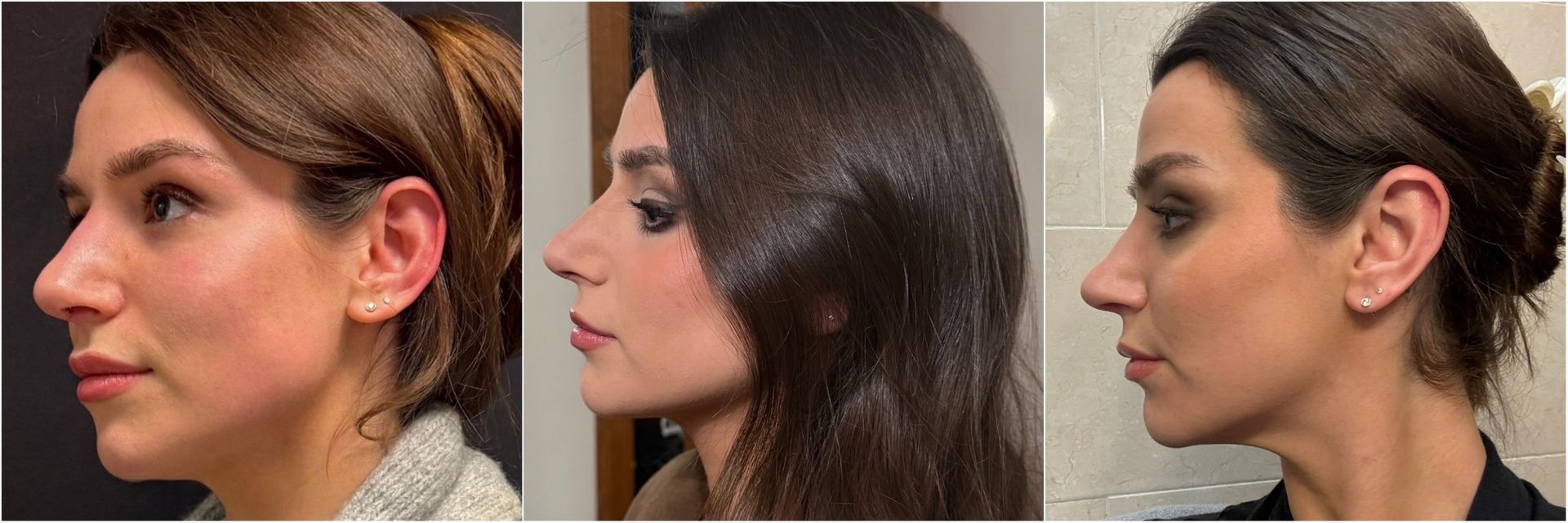 the same girl and a series of how her nose job swelled over the course of a week