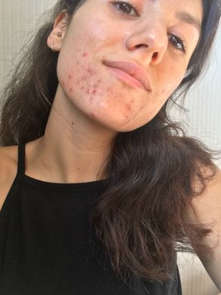 acne ruining sex life