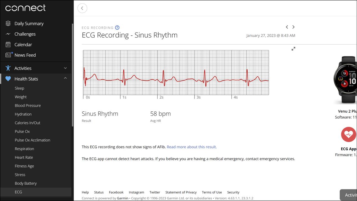 Garmin Venu 2 Plus EKG results