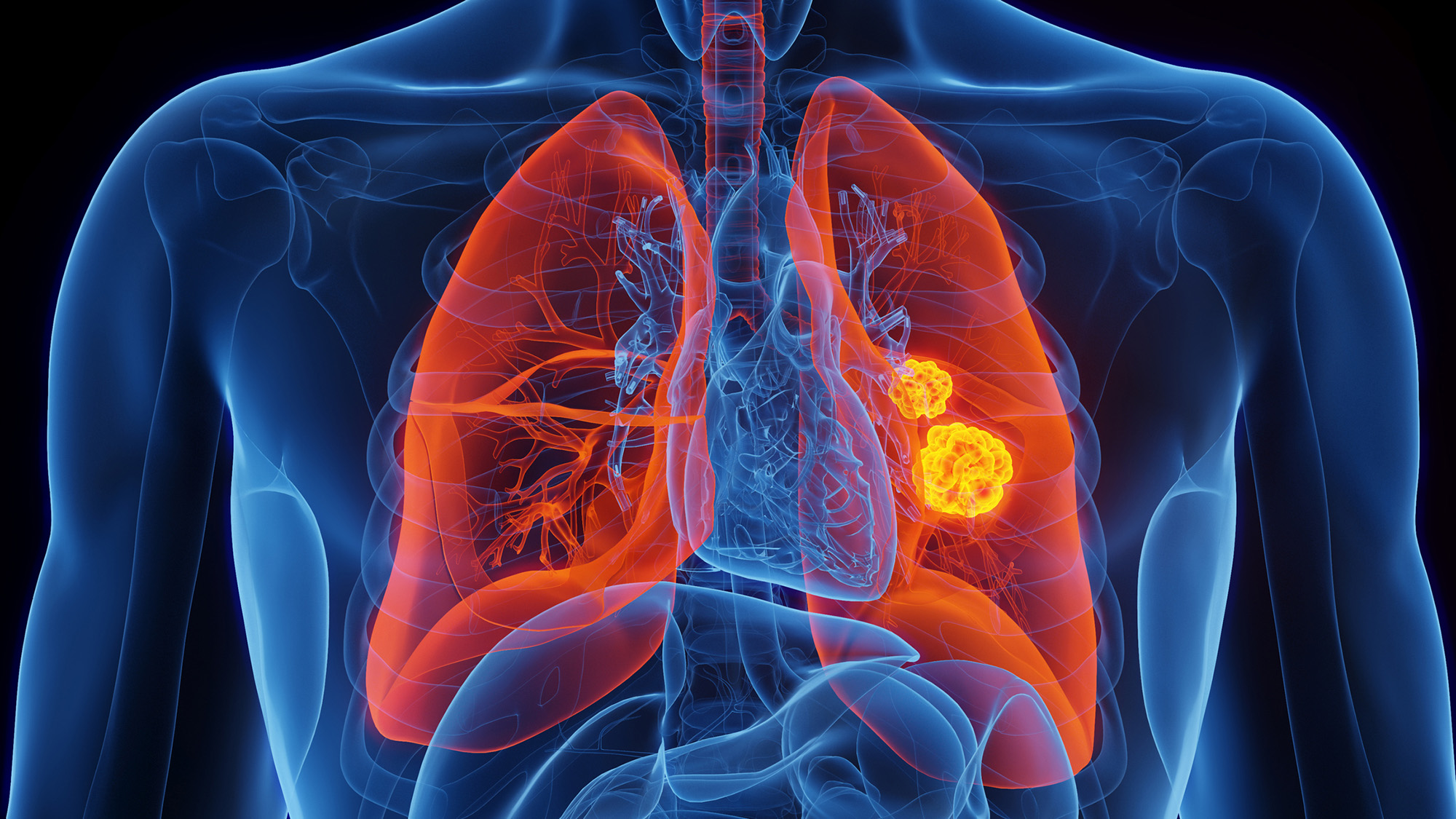 An illustration of a human torso showing the lungs in red with two yellow spheres in the left lung.