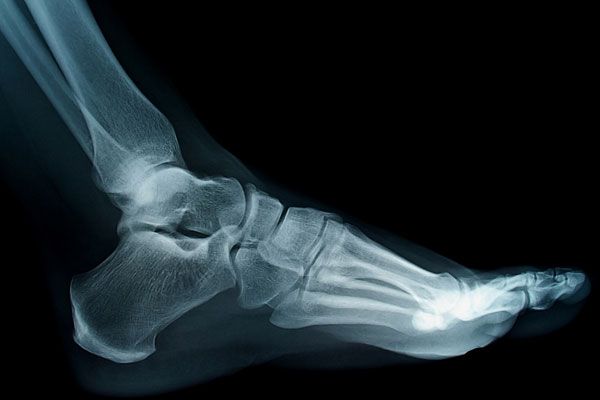 The tarsal bones include the lower part of the ankle, the large calcaneous or heel bone, and the smaller bones at the rear of the arch. The long bones at the front of the arch are the metatarsals.