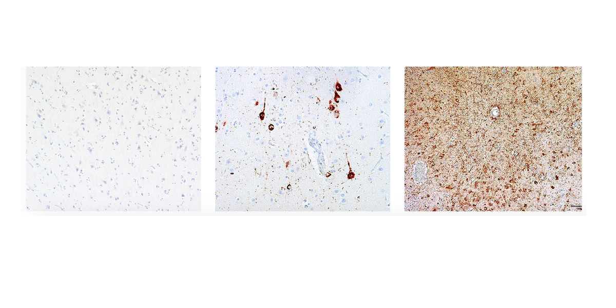 Images: Brains with CTE | Live Science