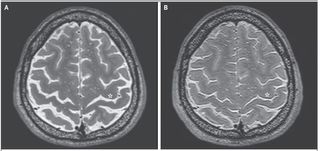 An MRI of an astronaut's brain before (panel A) and after (panel B) a long-duration spacefight.