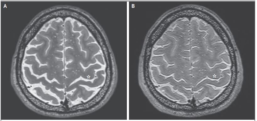 An MRI of an astronaut&#039;s brain before (panel A) and after (panel B) a long-duration spacefight.