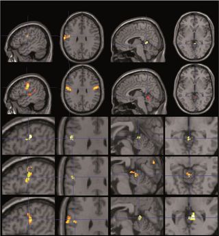 Functional activations in the regions identified by the structural analysis.