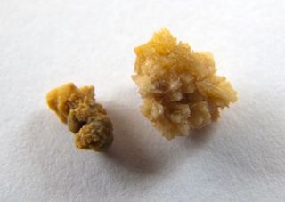 kidney stones form when there is not enough liquid to dilute waste chemicals in urine
