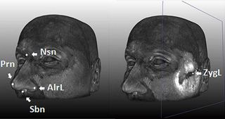 MRI scan of facial landmarks