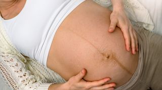 Linea Nigra: Pregnancy Line, Causes & When Does It Go Away