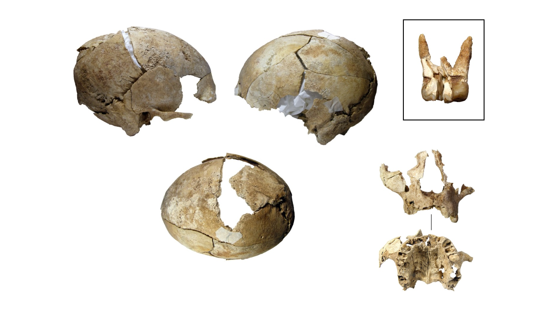 three views of a reconstructed broken human skull and a view of a tooth and part of a jaw