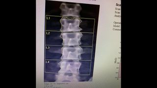 An X-ray image of the spine of NASA astronaut Raja Chari after his return to Earth,