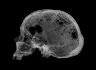A digitally reconstructed radiograph of the ancient skull reveals the holes caused by cancer.