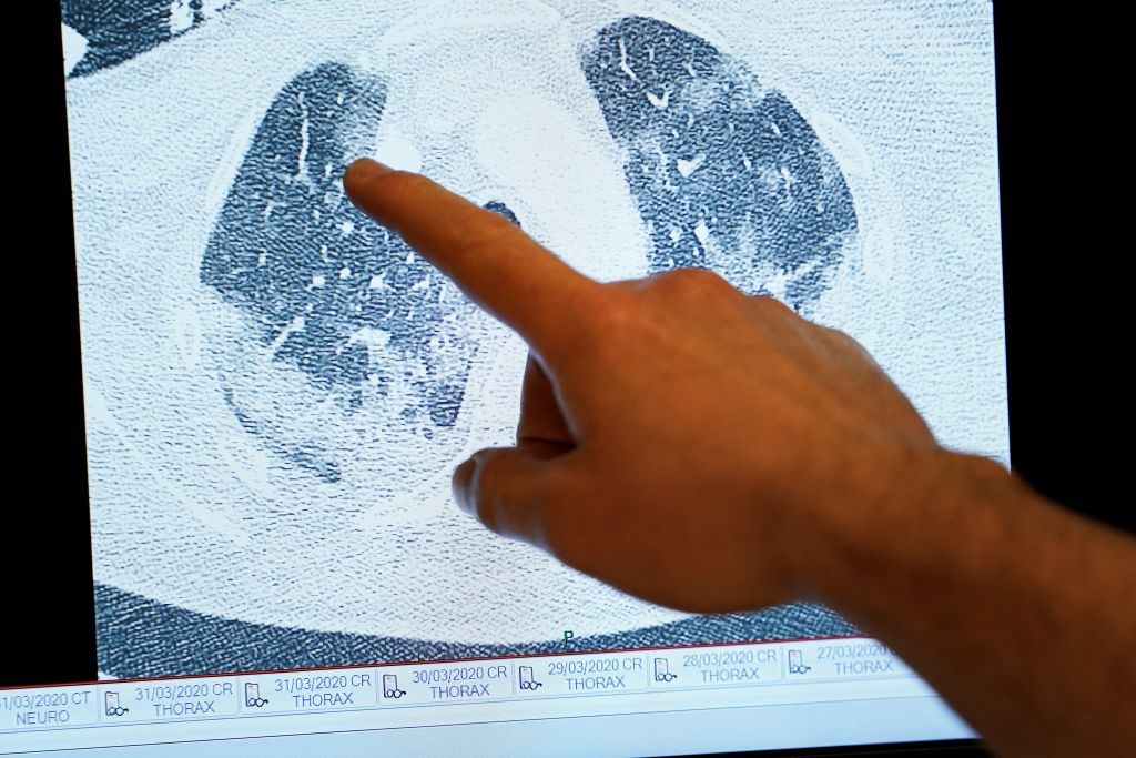 Coronavirus lung scan.