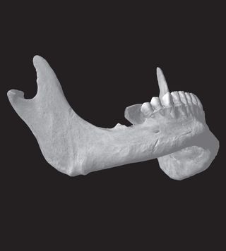 Here, a computed tomography (CT) scan of Richard III's jaw shows a linear slash mark 0.4 inches (10 millimeters) long on the right side of the chin, probably made by a sharp-edged dagger.