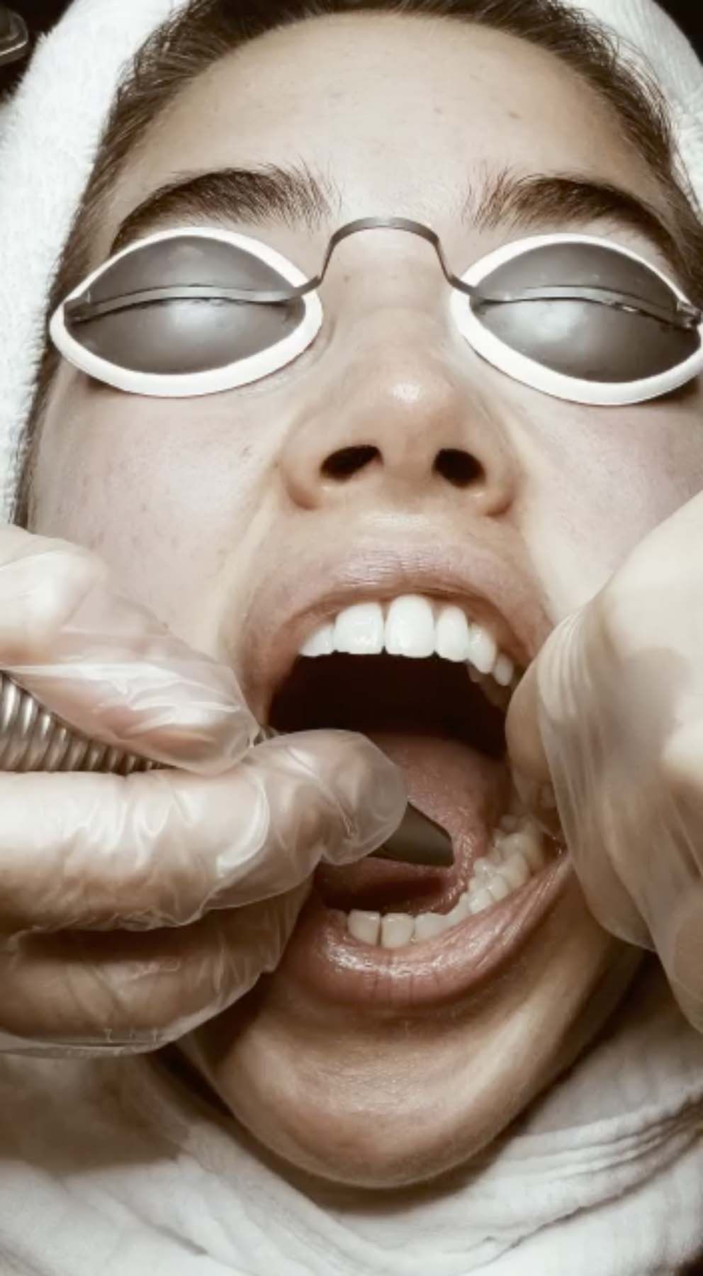 Isamaya Ffrench getting laser treatment