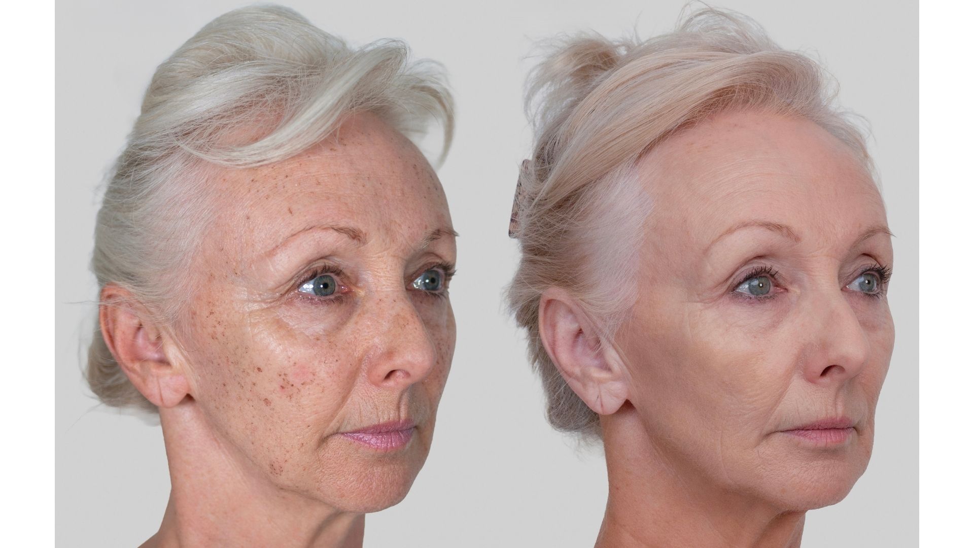 Debbie McGee Neogen before and after