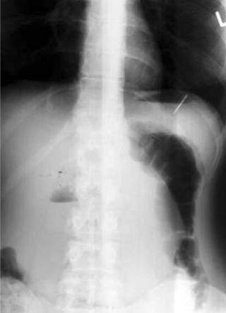 An X-ray showing radiopaque part of the toothbrush in the stomach of an 18-year-old woman.