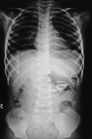 An X-ray showing a dental instrument swallowed by a 4-year-old boy.