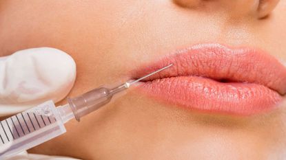 Lip Filler Injection