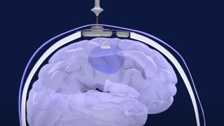 image shows a still from an animated video. The still shows a human brain and skull; a small, flat device implanted in the top of the skull emits a pulse of energy into the brain 