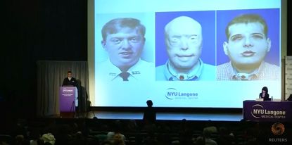 A slide showing Patrick Hardison before his face was burned, after his face was burned, and after his face transplant.