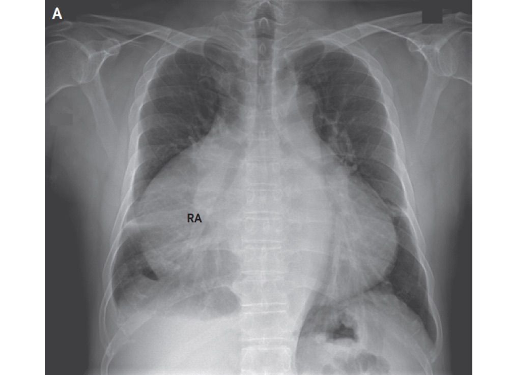 nejm, heart, atrium, right atrium, enlarged right atrium