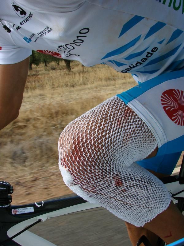 Gonzalo Rabu&ntilde;al's wounds from his stage 17 crash.