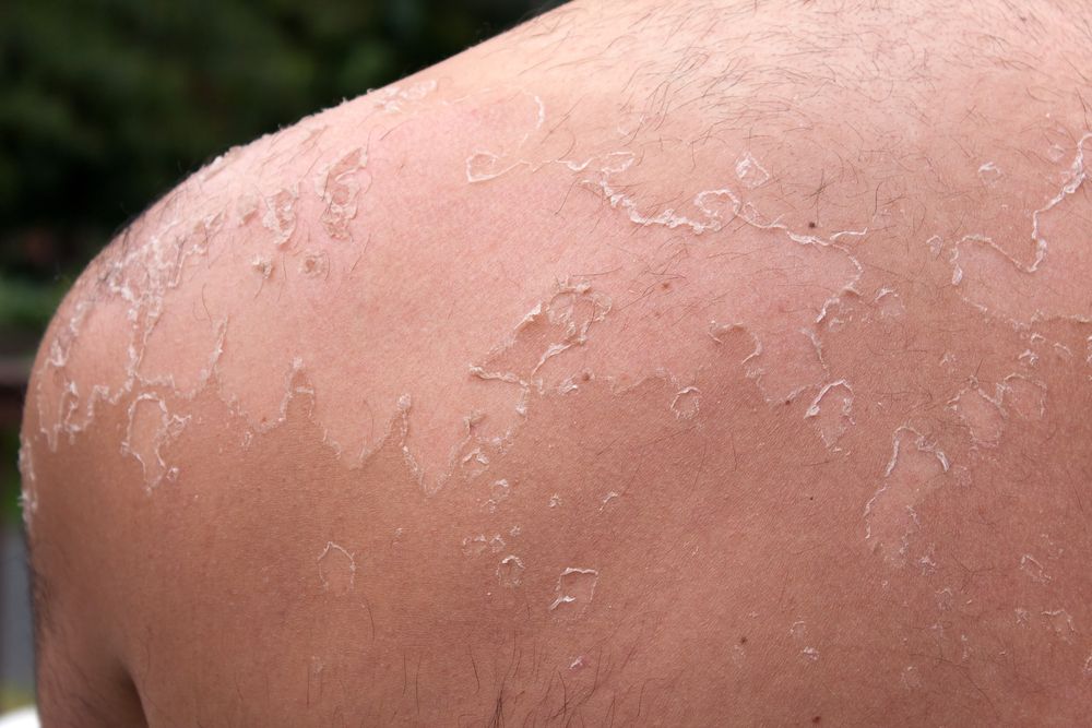 A man&#039;s shoulder is covered with peeling blisters. 