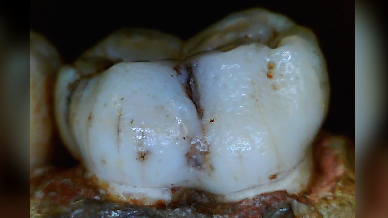 Close-up of a molar tooth with pits or dimples in the enamel