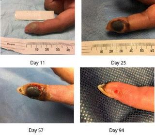 A lab worker became infected with a smallpox-related virus, known as the vaccinia virus, after she accidentally stuck her finger with a needle. Above, images of the patient's wound in the days and months after the accident. It eventually healed more than three months later.