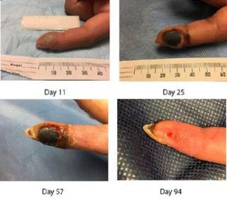 A lab worker became infected with a smallpox-related virus, known as the vaccinia virus, after she accidentally stuck her finger with a needle. Above, images of the patient&#039;s wound in the days and months after the accident. It eventually healed more than three months later.