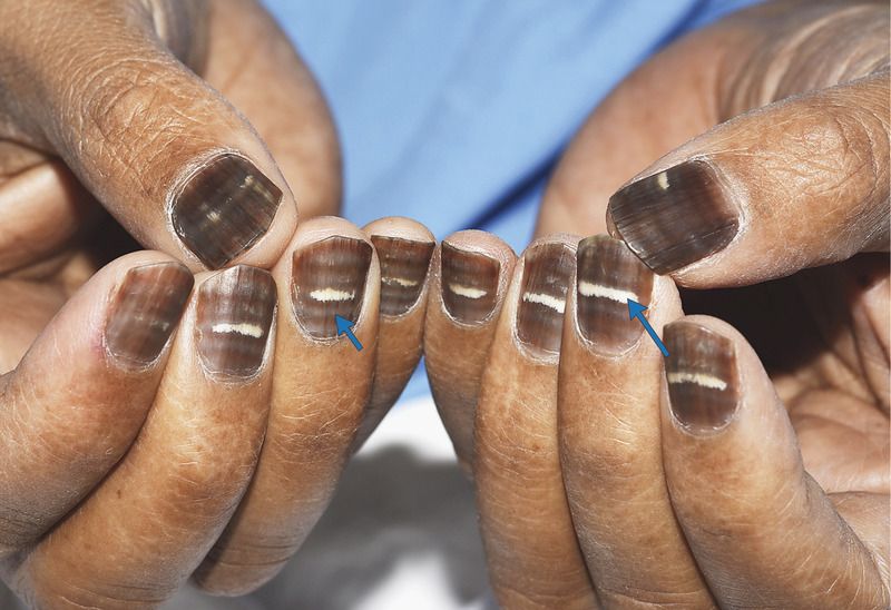 What Caused This Man s Nail To Turn Brown And Striped Live Science