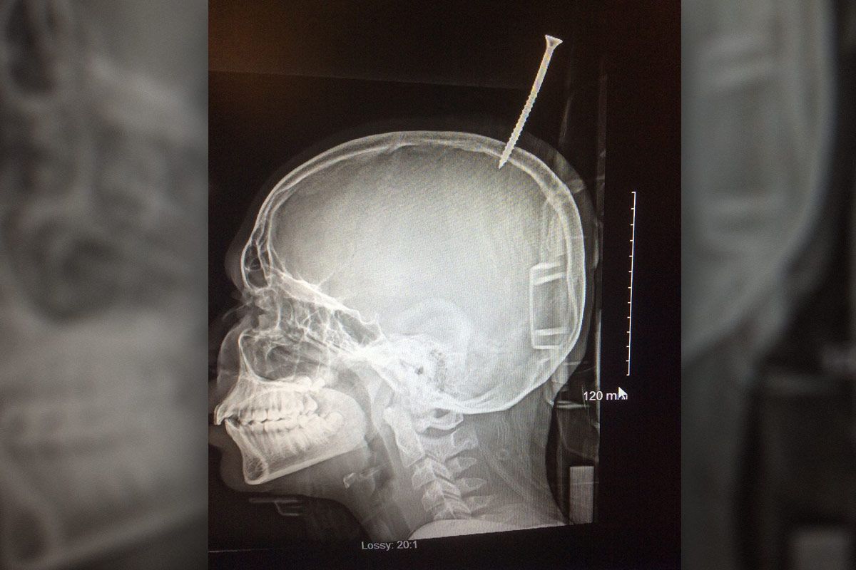 An X-ray showing the screw lodged in a teenager&#039;s skull.